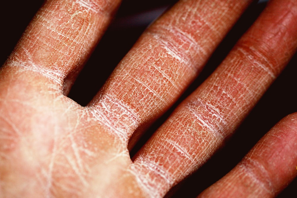  Things You Should Do To Keep Your Eczema From Flaring Up